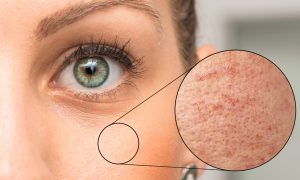 Read more about the article Pozbądź się przebarwień skórnych: jak leczyć i pielęgnować skórę?